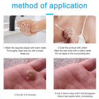 Skin-Tag-Remover, Wart Remover, Mole & Wart-Remover Liquid, Fast-Acting Skin-Tag-Remover for Tag Removal & Verruca-Treatment
