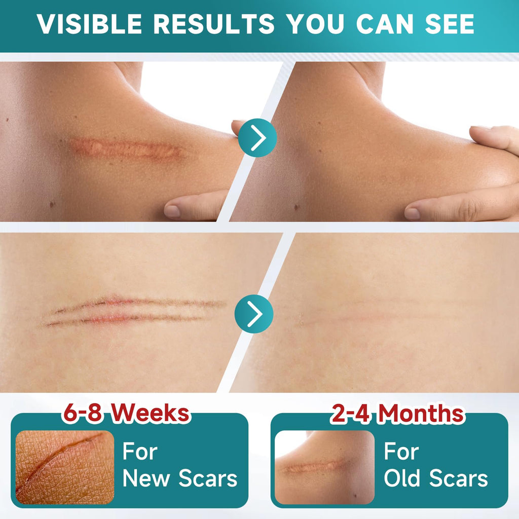 Pumkot Silicone Scar Sheets, Silicone Scar Tape(1.8” x 157” Roll-4M), Medical Grade Scar Removal Away Strips for Surgical Scars, Keloid, C-Section, Burn - Stickiness Upgrade, Waterproof, Reusable