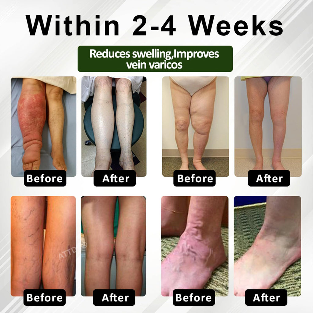 Fluidease Leg Therapy Edema Cream, Fluid Ease Leg Therapy Cream, Lymphatic Drainage Massage Cream, Swell Care Lymphatic Massage Cream, Edema Relief for Legs and Feet (1)
