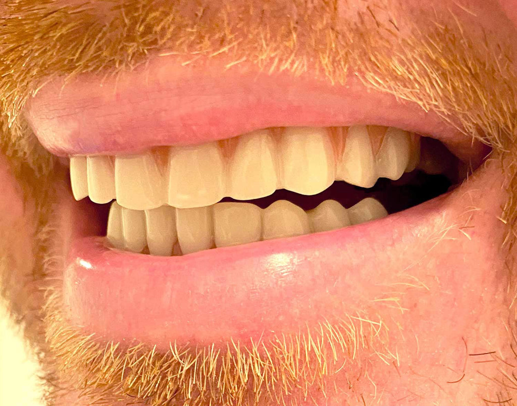 Instant Smile Comfort Fit Flex Teeth - Top & Bottom Matching Set Natural Tone Fix Your Smile At Home Within Minutes