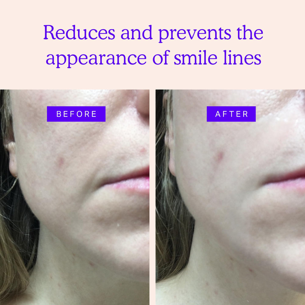 BLUMBODY Smile Line Patches – Face Wrinkle Patches for Fine Lines Around Mouth, between Eyes – Non-Silicone Anti-Wrinkle Facial Tape – Comfortable Overnight Use (90-Day Supply)