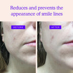 BLUMBODY Smile Line Patches – Face Wrinkle Patches for Fine Lines Around Mouth, between Eyes – Non-Silicone Anti-Wrinkle Facial Tape – Comfortable Overnight Use (90-Day Supply)
