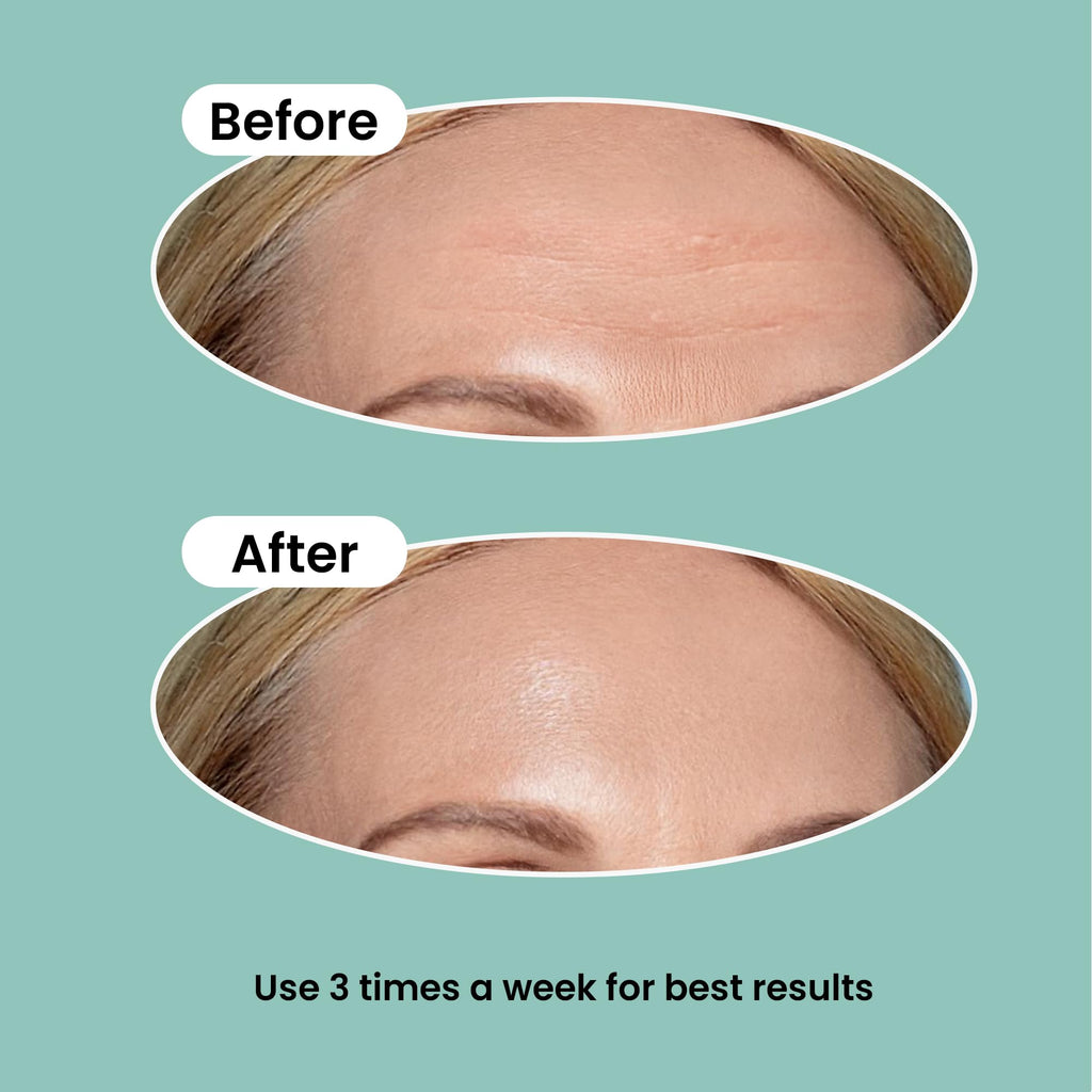 NURIVE Advanced Wrinkle Patches 20ct Smile Line, Frown Line Wrinkle Patches for Facial Korean Skin Care Face Wrinkle Tape Invisible Overnight with Retinol & Collagen (Large (Forehead))