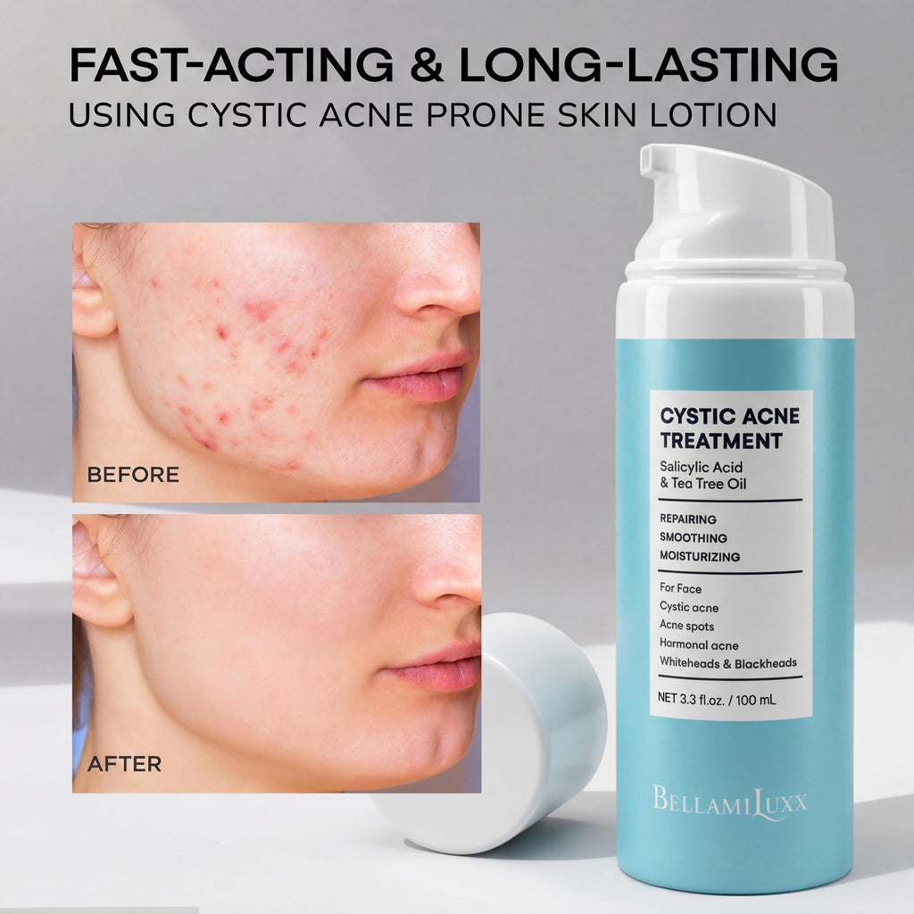 BellamiLuxx Cystic Acne Treatment for Face: Hormonal Acne Treatment Cream for Teens & Adults - Salicylic Acid & Tea Tree Oil Pimple Spot Remover - Anti-Acne Moisturizer Reduces Redness, Blemishes