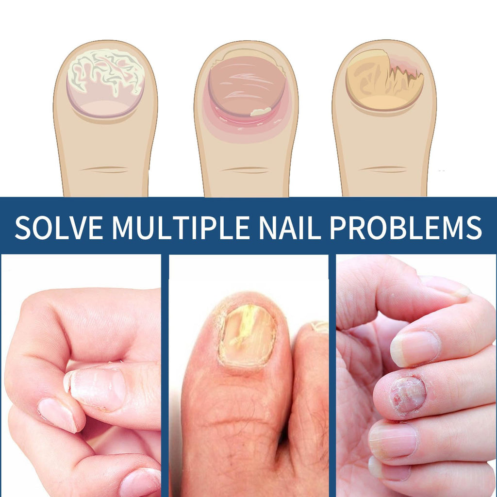 64PCS Fungal Nail Patches, Fungal Nail Treatment for Toenails Extra Strong, Fast-Acting Nail Fungal Treatment Patches for Damaged & Thick Nails, Overnight Repair & Long-Lasting Relief