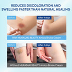 Arnica Bruise Cream Extra Strength: Fast Healing for Bruising and Swelling on Thin & Sensitive Skin - Enriched with Arnica Montana & Vitamins K, C & E - Daily Care for Teens, Adults & Seniors 4oz