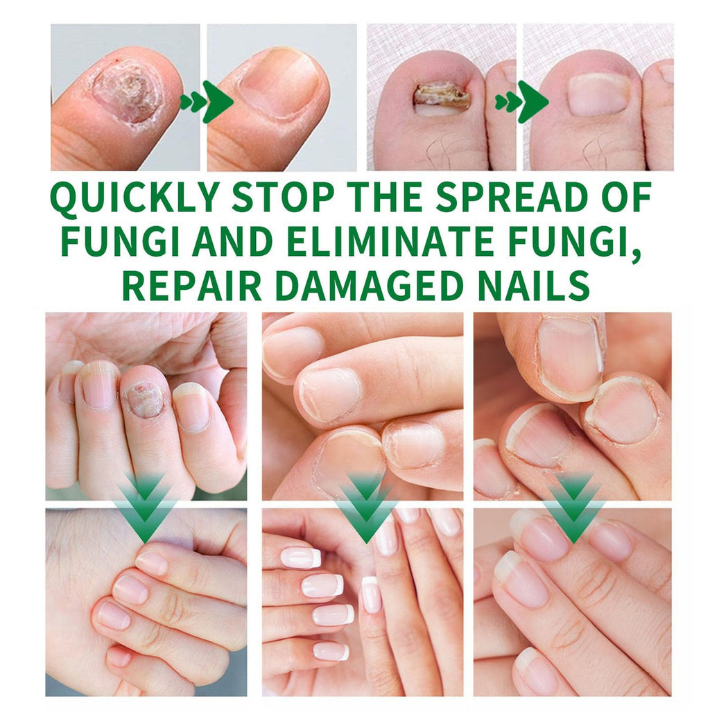 Ginger Toenail Fungus Treatment, Fungal Nail Treatment, Ginger Nail Growth Serum,7 Days Nail Treatment, Antifungal Nail Repair Serum, Fast-Acting Recovery for Thick, Discolored, Yellow Nails