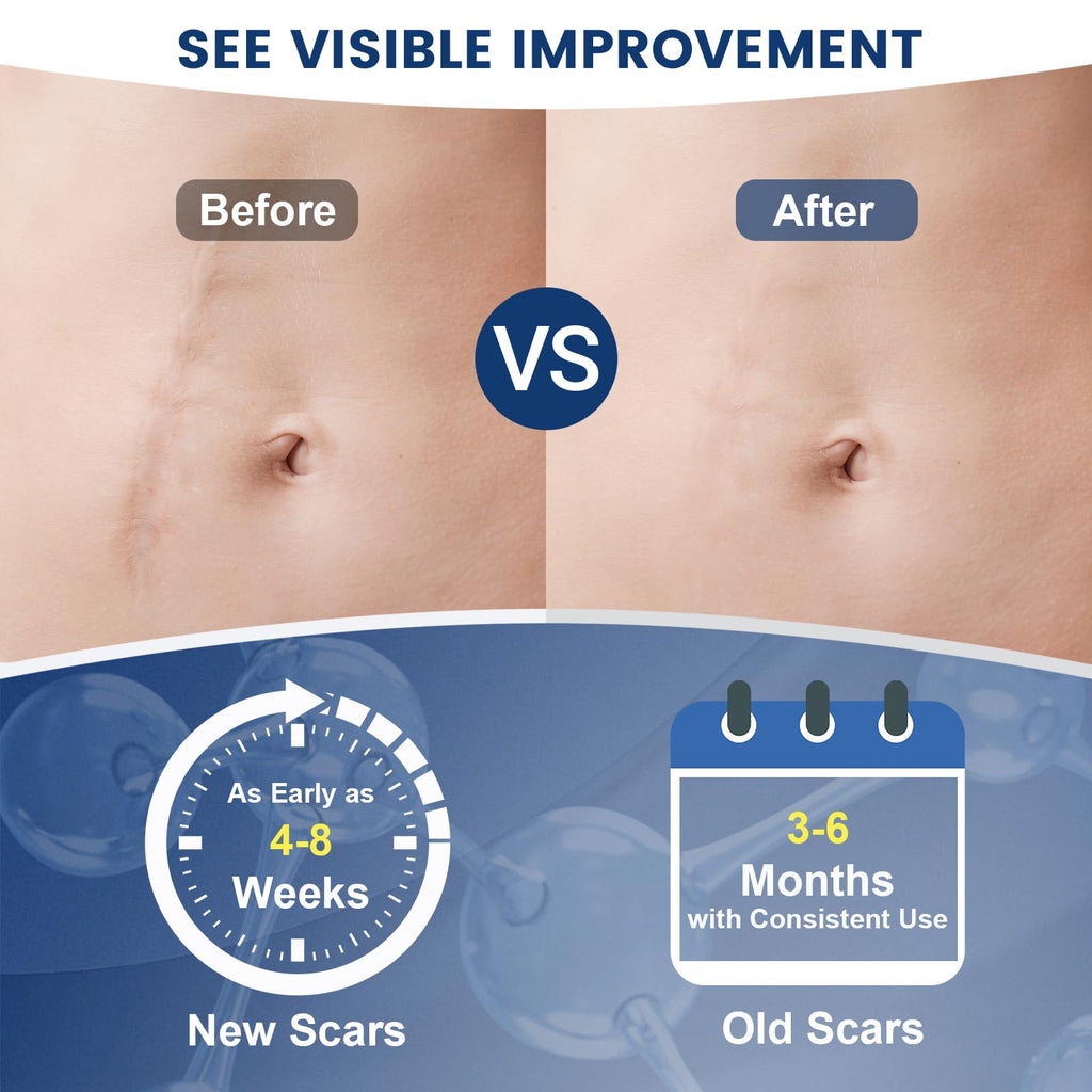 Rvlaim 100% Silicone Scar Gel Scar Cream, Advanced Silicone Gel for Removal of Surgical, Burns, Acne Scar, Old and Recent Scars and Stretch Marks, 1.7 oz/50ml
