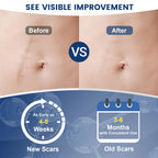 Rvlaim 100% Silicone Scar Gel Scar Cream, Advanced Silicone Gel for Removal of Surgical, Burns, Acne Scar, Old and Recent Scars and Stretch Marks, 1.7 oz/50ml