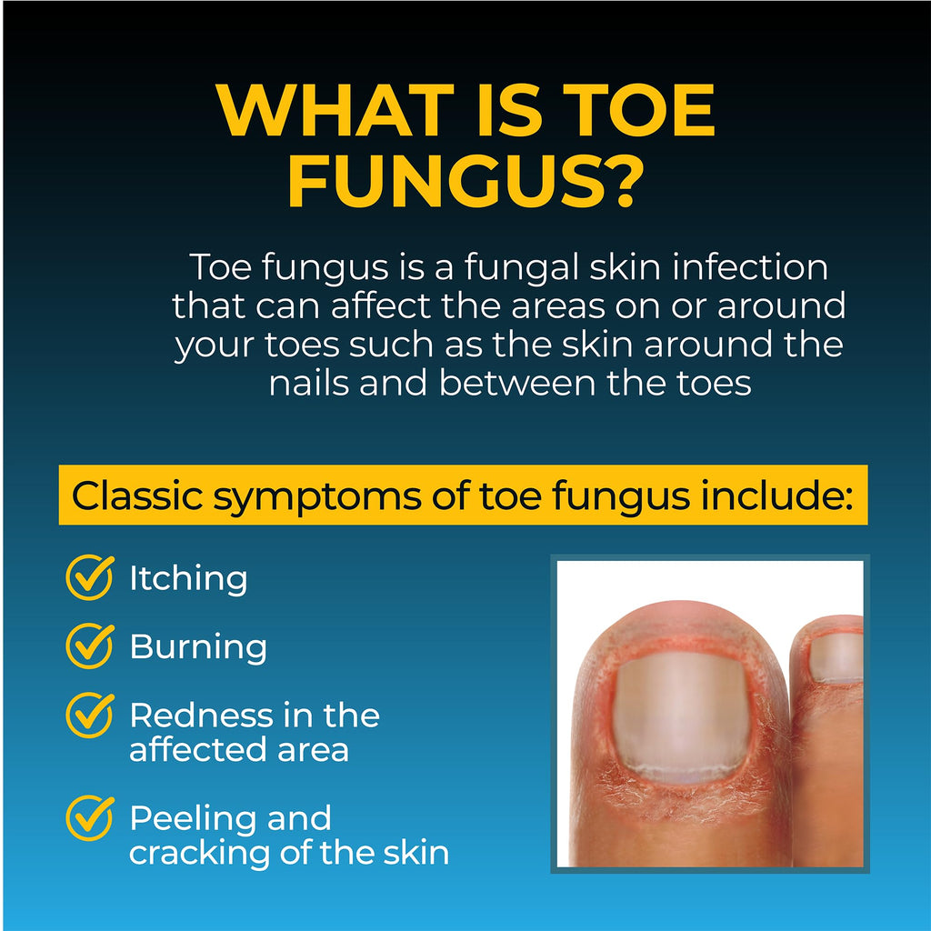 Fungi Nail Anti-Fungal Ointment 0.7 Fl Oz,Kills Fungus that Can Lead To Athlete's Foot with Tolnaftate,Toe Nail Fungus Treatments,Clinically Proven to Cure Infections,Natural Color,(Pack of 2)