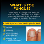 Fungi Nail Anti-Fungal Ointment 0.7 Fl Oz,Kills Fungus that Can Lead To Athlete's Foot with Tolnaftate,Toe Nail Fungus Treatments,Clinically Proven to Cure Infections,Natural Color,(Pack of 2)