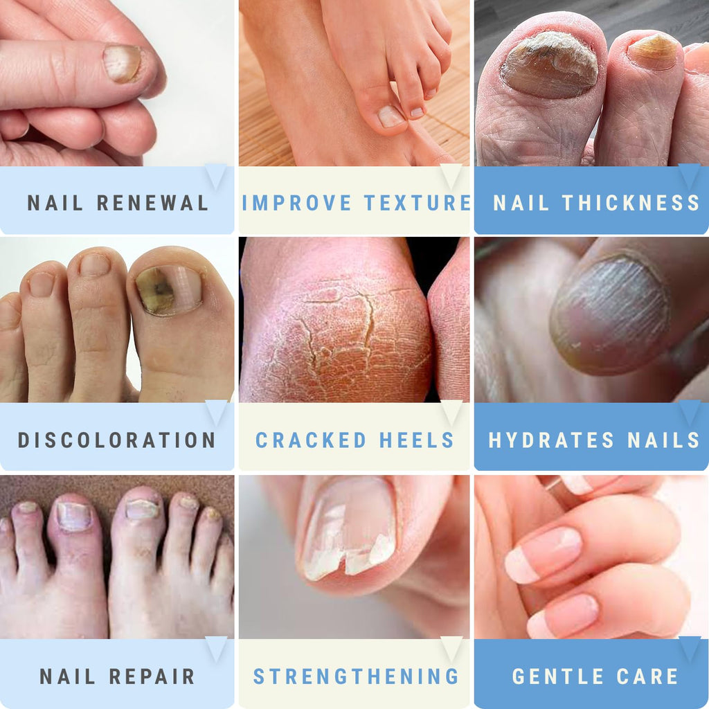 Urea 50% Nail Gel - Softens Cracked Heel Calluses & Thick Toenails - Repairs Damaged, Yellow, Discolored Nails – Highly Effective & Quick-Dry Fingernails & Toenail Treatment