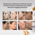 CLEARSTEM - MINDBODYSKIN Hormonal Acne Supplement (5-HTP) - Natural DIM Supplement - Skin Care Vitamins - Hormone Balance, Antioxidants - Gluten Free, Cruelty Free - 30 Servings, 90 Capsules