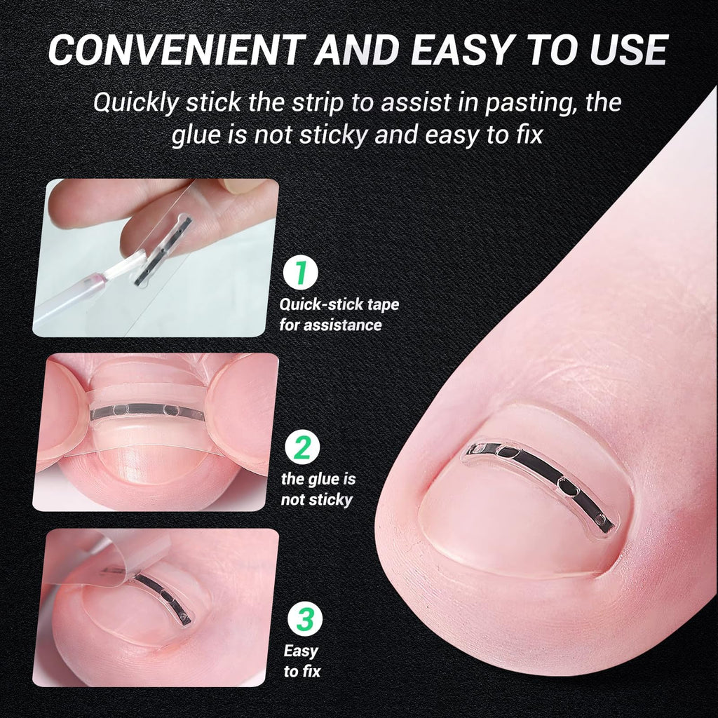 Reieset Titanium Alloy Ingrown Toenail Treatment, Nail Tools, and Ingrown Toenail Removal Kit Specially Designed for Curved Nail Repair and Ingrown Toenail Corrector (0.59/0.67in)