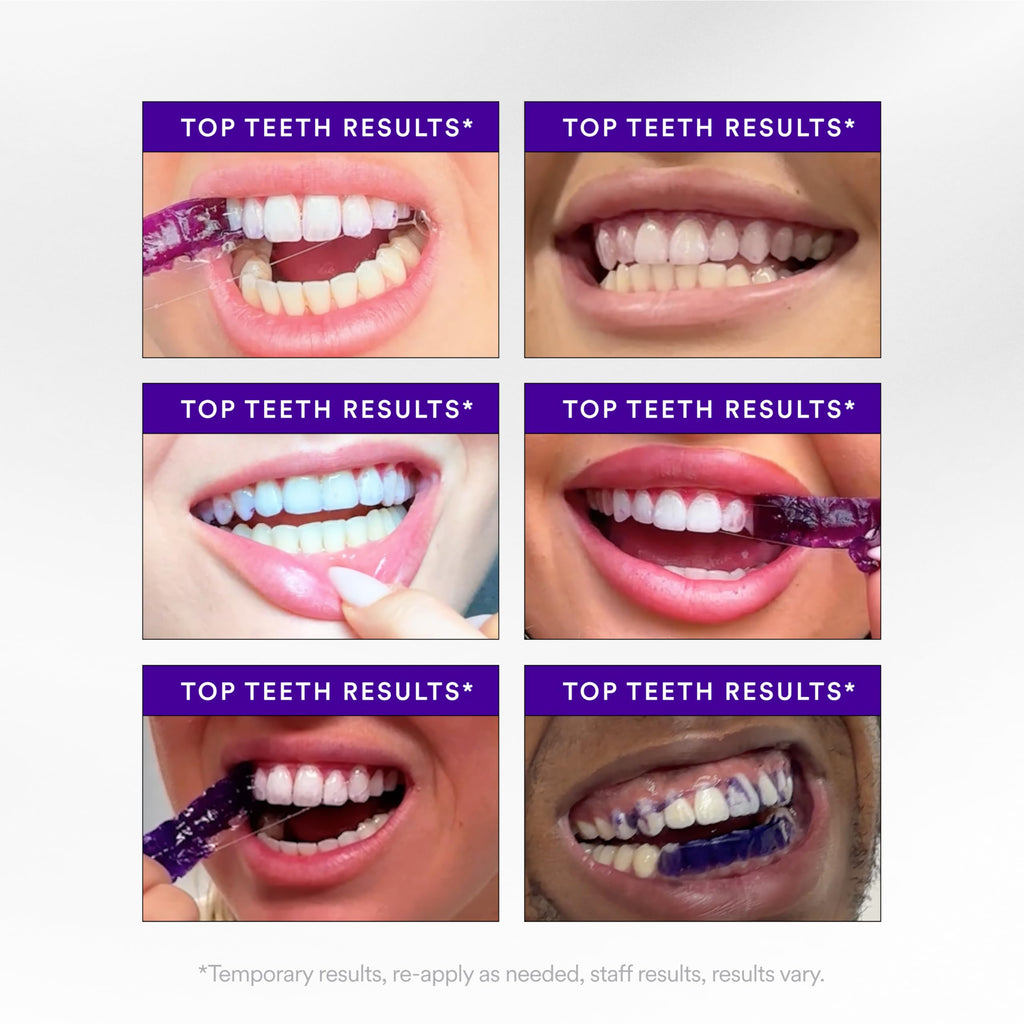Hismile V34 Whitening Strips, Teeth Whitening Strips, Purple Tooth Whitening, Purple Whitening Strips, Tooth Stain Treatment, Combining Whitening and Colour Correction