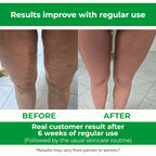 TESMED Cellulite Manual Massager : Made in Italy, Patented with Converging & Diverging Roller Technology. Anti Cellulite Roller for Thighs and Buttock