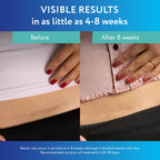 ScarAway Advanced Clear Silicone Scar Sheets, Medical Grade Silicone Strips (1.5" x 3") Scar Treatment and Prevention for Surgical, Burn, Body, Hypertrophic & Keloid Scar Treatment, 10 Clear Sheets