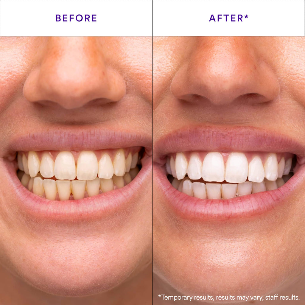 Hismile V34 Whitening Strips, Teeth Whitening Strips, Purple Tooth Whitening, Purple Whitening Strips, Tooth Stain Treatment, Combining Whitening and Colour Correction