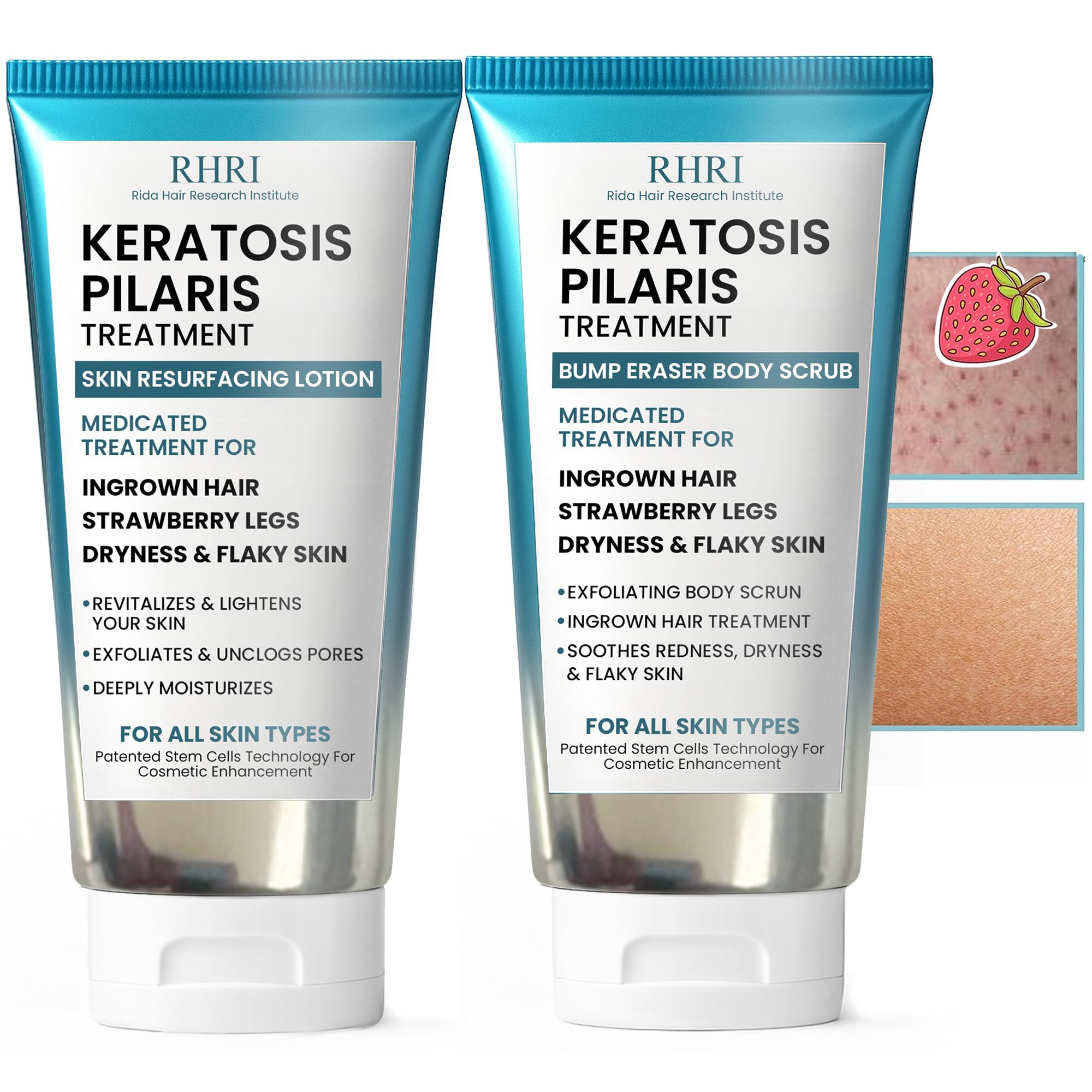 KP Bump Eraser Body Set with 10% AHA | Keratosis Pilaris Treatment | Keratosis Pilaris Lotion | Exfoliating Body Scrub | Ingrown Hair Treatment | Bundle Set for Bump, Strawberry Legs, Redness, Dryness