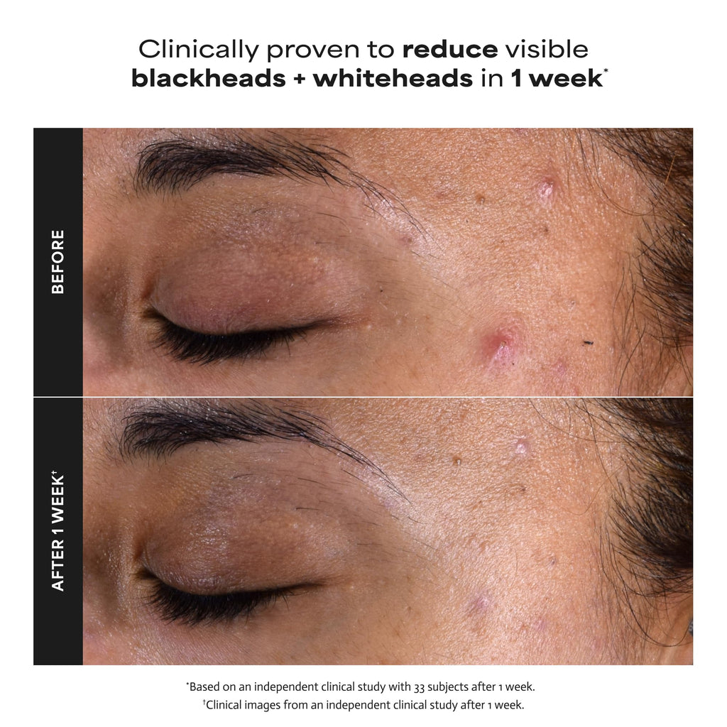 Paula's Choice SKIN PERFECTING 2% BHA Liquid Exfoliant with Salicylic Acid, Facial Polish for Pores, Wrinkles & Fine Lines, Suitable for Blackhead-Prone Skin, Fragrance-Free (5 Fl Oz (Pack of 2))