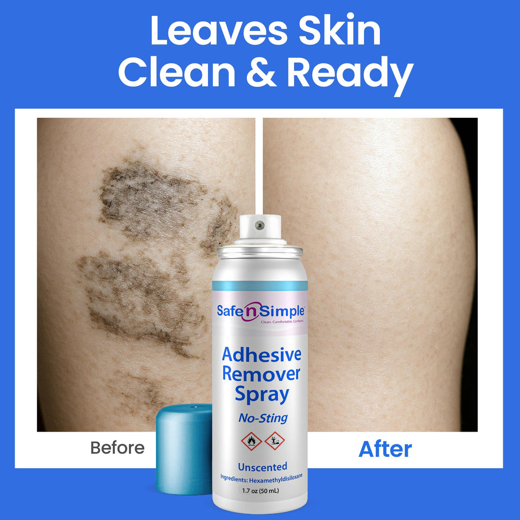 Safe n’ Simple Medical Adhesive Remover Spray for Skin - 1.7 Fl Oz No Sting Alcohol Free Ostomy Adhesive Remover - Gentle Medical Adhesive Removal Spray for Stoma, Urostomy, Ileostomy & Colostomy Care