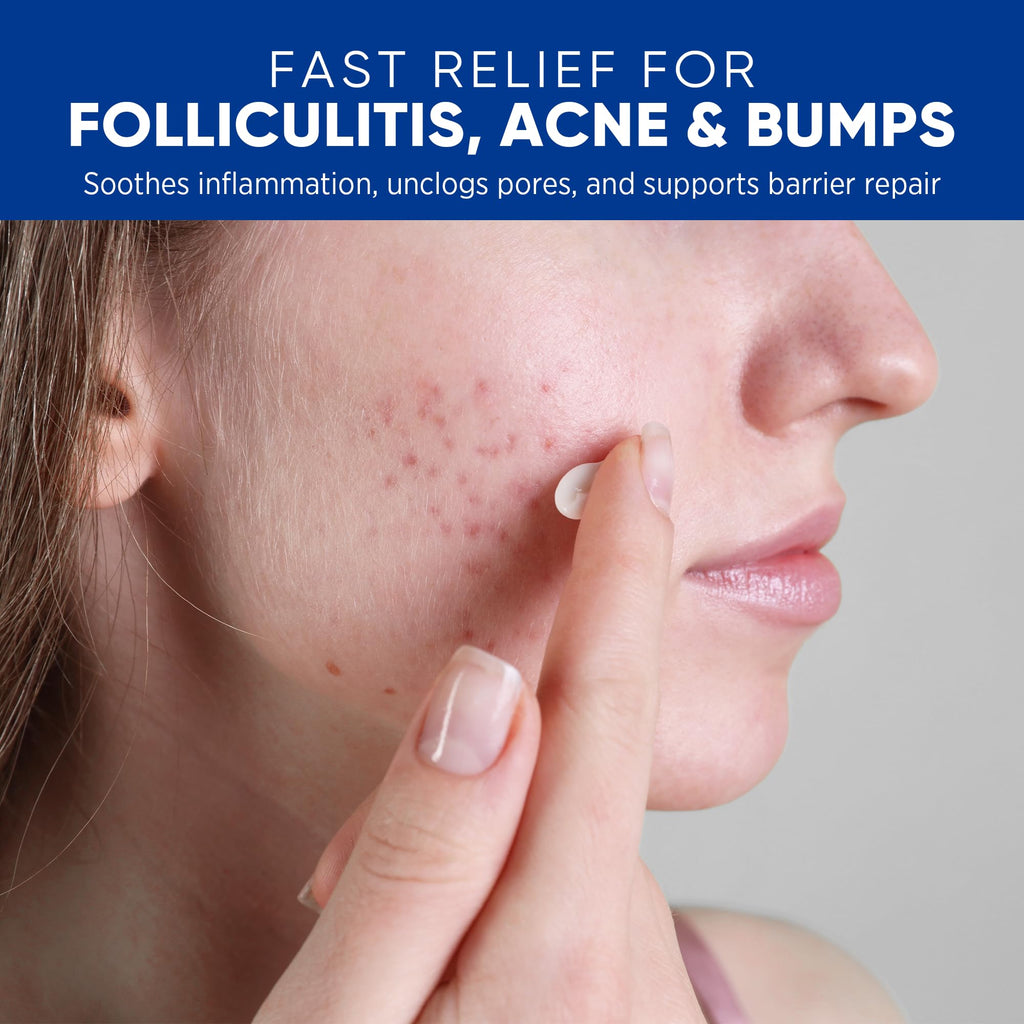 AOSORW Folliculitis & Acne Treatment Cream – Salicylic Acid & Herbal Extracts for Scalp, Face, Body & Back – Soothes Irritated Skin, Redness & Itch Relief – 100g (Pack of 1)