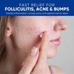 AOSORW Folliculitis & Acne Treatment Cream – Salicylic Acid & Herbal Extracts for Scalp, Face, Body & Back – Soothes Irritated Skin, Redness & Itch Relief – 100g (Pack of 1)