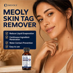 MEOLY Fast-Acting Skin Tag Remover : Salicylic Acid Skin Tag for Men and Women 30 ml