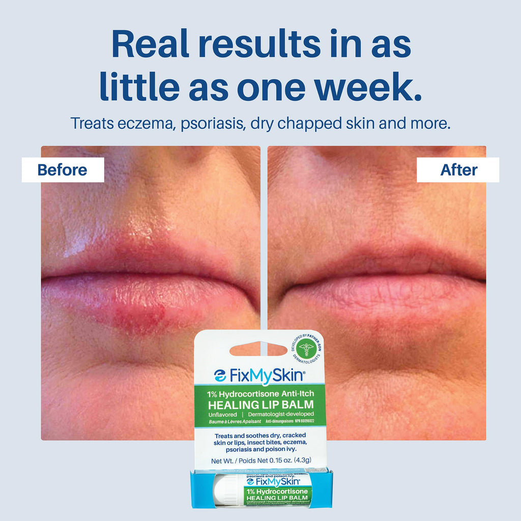 FixMySkin 1% Hydrocortisone Healing Lip Balm, Unflavored – Soothes Dry, Cracked & Irritated Lips, Relieves Chapped Lips, Cold Sores & Eczema, Dermatologist Developed, Travel-Friendly Tube, 0.15 oz
