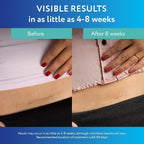 ScarAway Advanced Clear Silicone Scar Sheets, Medical Grade Silicone Strips (1.5" x 3") Scar Treatment and Prevention for Surgical, Burn, Body, Hypertrophic & Keloid Scar Treatment, 6 Clear Sheets