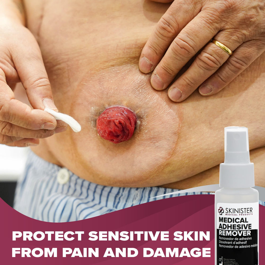 Skinister Medical Adhesive Remover for Skin | Wig, Ostomy, Tape, and Bandage Adhesive Remover | Silicone-Based, Hypoallergenic, Sting-Free | 4oz Spray