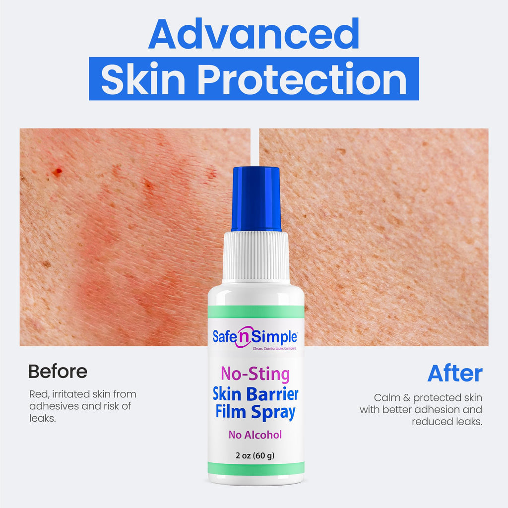 Safe n' Simple Skin Barrier Spray No-Sting - 2oz Bottle - Alcohol-Free Skin Prep Spray, Odor-Free Barrier Film for Ostomy Care, Stoma Skin Protection, Adhesive Prep for Medical Tapes and Dressings