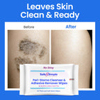 Safe n’ Simple Resealable Adhesive Remover Wipes for Skin - 50 Large 5"x7" No Sting Alcohol Free Medical Adhesive Remover Pads for Ostomy, Stoma Care - Gentle Adhesive Removal Wipes for Bandages, Tape