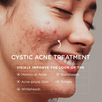 Cystic Acne Spot Treatment for Face: Hormonal Acne Pimple Cream with Salicylic Acid & Tea Tree Oil - Hormonal & Pimple Cream for Teens & Adults,120 Day Supply & 3.38 oz / 100 ml