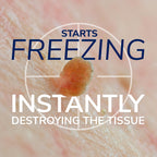 Dr. Scholl's Freeze Away Skin Tag Remover Kit, 8 ct – Completely removes Skin Tags in As Little As 1 Treatment, FDA-Cleared & Clinically Proven At-Home Removal, Easy 1-Handed Action, Permanent Results