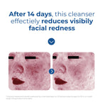EltaMD Skin Recovery Amino Acid Foaming Cleanser, Gentle Face Cleanser for Sensitive Skin, Proven to Gently Remove Makeup and Sunscreen,Fragrance Free and Noncomedogenic, Foaming Face Wash, 5 oz
