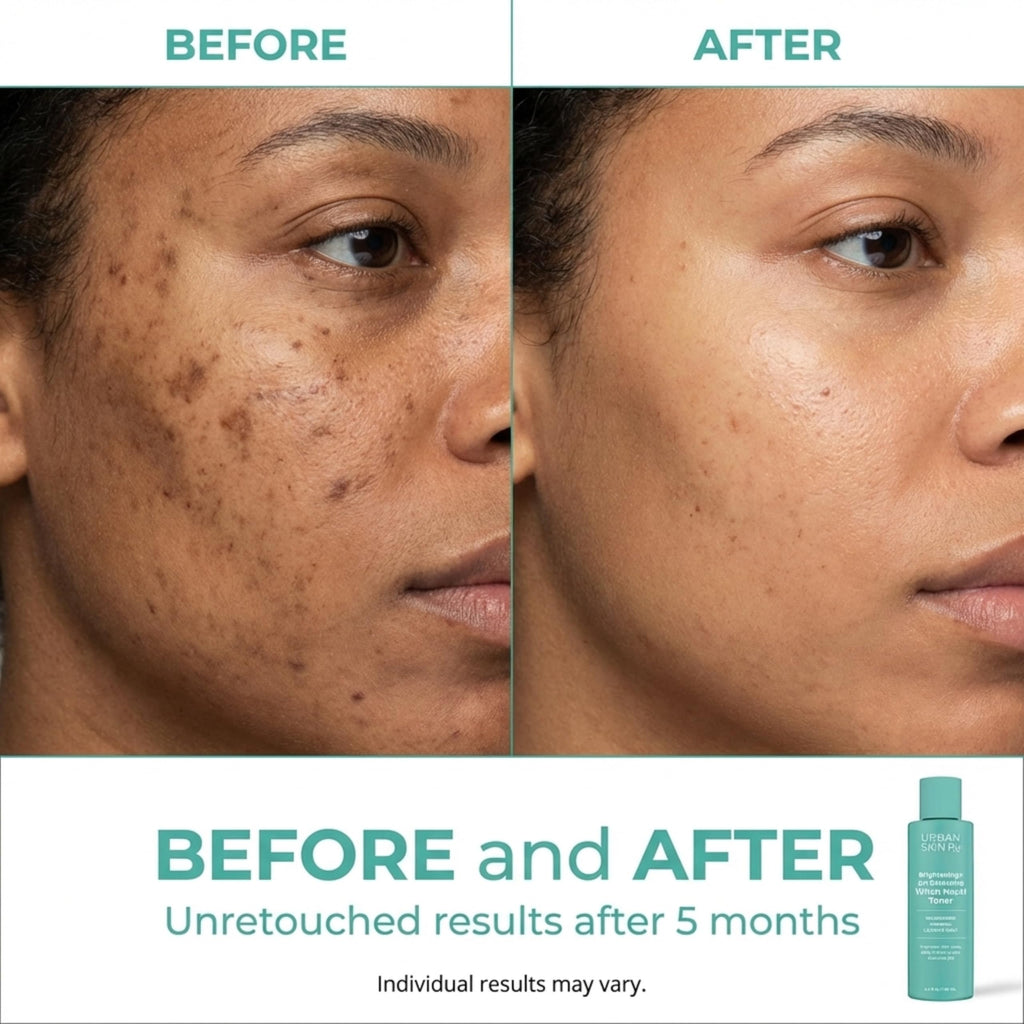 Urban Skin Rx® Witch Hazel Brightening & pH Balancing Toner, Exfoliated & Clarifies Clogged Pores, Improves The Appearance of Uneven Skin Tone, Reduces Redness & Brightens Dull Complexions, 4.5 Fl Oz