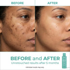 Urban Skin Rx® Witch Hazel Brightening & pH Balancing Toner, Exfoliated & Clarifies Clogged Pores, Improves The Appearance of Uneven Skin Tone, Reduces Redness & Brightens Dull Complexions, 4.5 Fl Oz