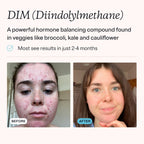 MDacne DIM Skin Clearing Supplements (30 Vegan Capsules) - for Acne Treatment, Estrogen Balance, Hormone Menopause Relief & Bodybuilding, Cruciferous Extract & Bioperine (30 Count (Pack of 1))
