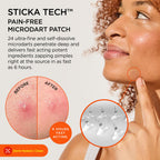 ZitSticka KILLA Kit Microdart Pimple Patches – Advanced Microdart Patch for Early-Stage Zits - Targeted ZitSticka Microdart Pimple Patch & Spot Patches for Breakout Control - 20 Count