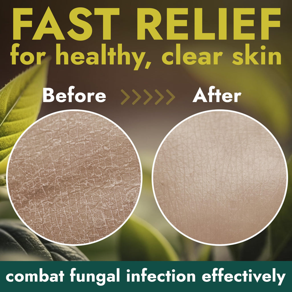 Antifungal Body Wash with Tea Tree Oil | Antifungal Soap Treats Ringworm, Back Acne, Eczema & Jock Itch | Antifungal Body Soap For Men And Women (16.9 oz)