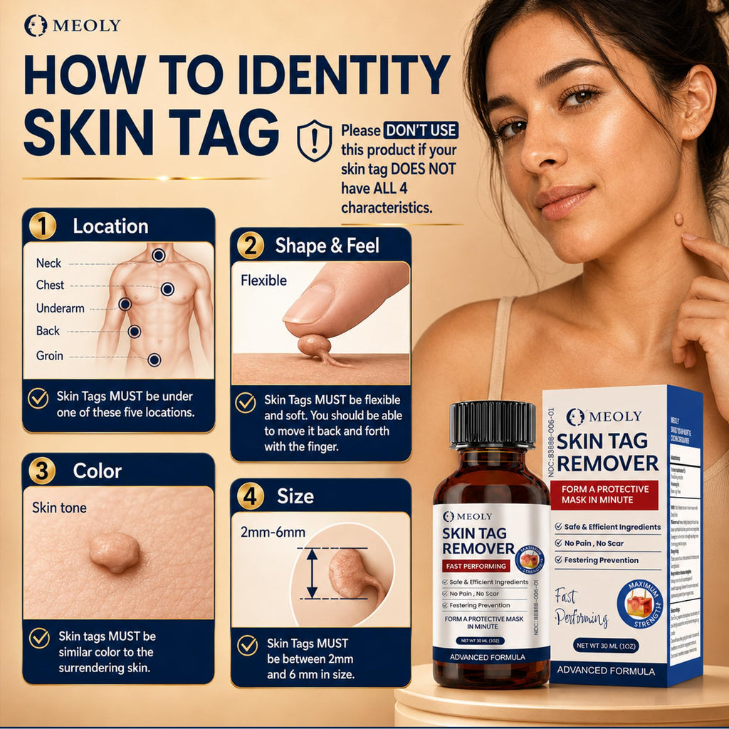 MEOLY Fast-Acting Skin Tag Remover : Salicylic Acid Skin Tag for Men and Women 30 ml