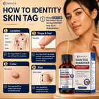 MEOLY Fast-Acting Skin Tag Remover : Salicylic Acid Skin Tag for Men and Women 30 ml