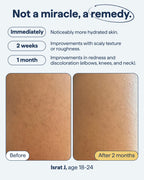 Remedy for Body Bumps | KP Exfoliating Body Moisturizer | Keratosis Pilaris (KP) Treatment For Textured, Crepey Skin with Urea, Lactic Acid, Retinol | Smoothing Body Lotion | By Dermatologist Dr. Shah