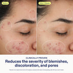 Skinfix 2% BHA Cleanser - 5 oz - Clears Acne Blemishes & Blackheads - Safe for All Types of Acne - Fragrance Free - Vegan, Cruelty Free