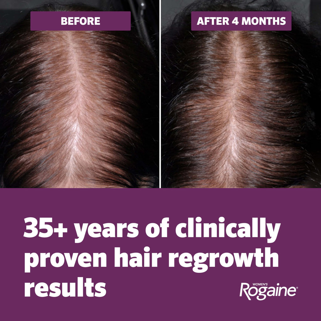 Women's Rogaine 5% Minoxidil Topical Foam, Unscented, 2 x 2.11 oz