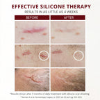 HealFast Silicone Scar Gel & Cream for Surgical Scars - Medical Grade Scar Treatment & Removal for Keloid, Acne, Burns, C Section, Stretch Marks - Physician Formulated Advanced Silicone Gel for Scars