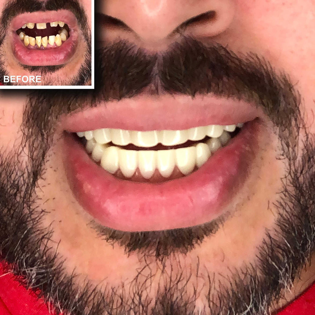 Instant Smile Comfort Fit Flex Teeth - Top & Bottom Matching Set Natural Tone Fix Your Smile At Home Within Minutes