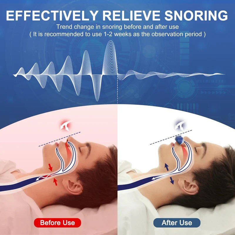 Electric Anti Snoring Device,Stop Snoring Solution,Adjustable Wind Speed Anti Snoring Devices,Breathable Snoring Prevention for Men Women,Universal All Nose Shapes (Blue)