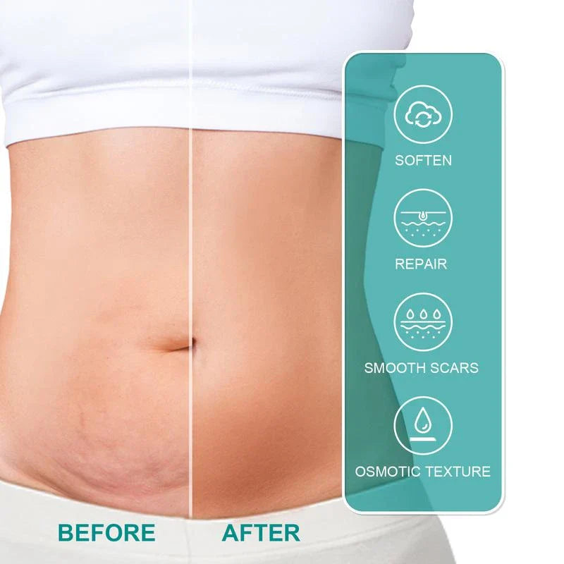 South Moon （Buy 1 Get 1 Free）South Moon Scar Care Spray Fades Scare pregnancy  Smoothing Skin Care Spray Medical Grade Scar Spray - Specification: Buy 2 Get 2 Free